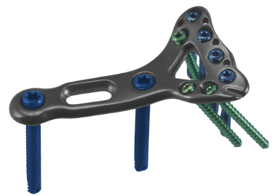 Placa para Radio Distal Medial (YAP)