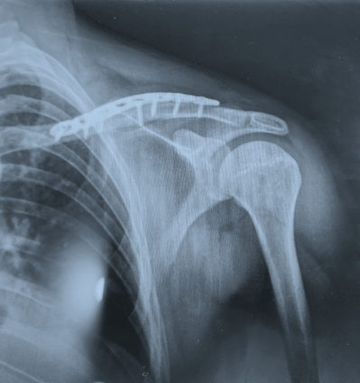 Placa para clavícula en "S"