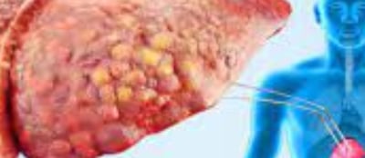 drug induced fatty liver