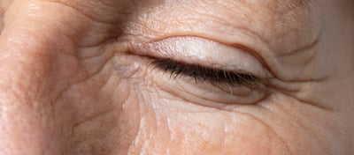skin wrinlkes and fine lines