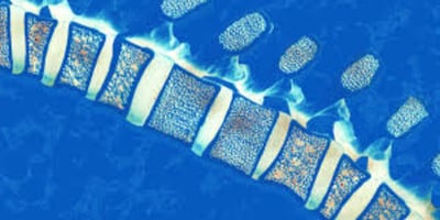 multiple myloma cord compression