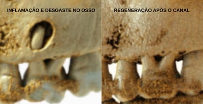 imagem do osso regenerado após o tratamento de canal