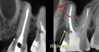 tomografia de dois dentes com reabsorções externas