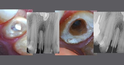 sequencia de fotos clínicas e radiografias de remocao de pino de fibra