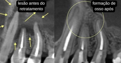 radiografia antes e depois do retratamento de canal, com formação de osso