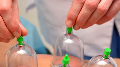 cupping-therapy treatment near Kalaburagi, Karnataka,