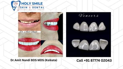 veneer for better smile by Dr Amit Nandi n Jora Girja Kolkata