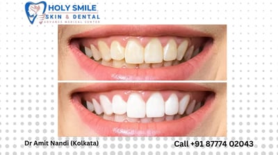 teeth whitening kolkata
