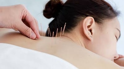 dry needling therapy for cervical pain to release trigger points.