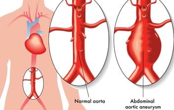 Assessment of patients with abdominal aortic aneurysm (open surgery and keyhole)