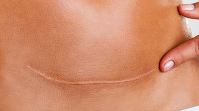 osteopatia per il trattamento delle cicatrici 