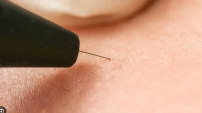 eletrólise remoção de pelos brancos