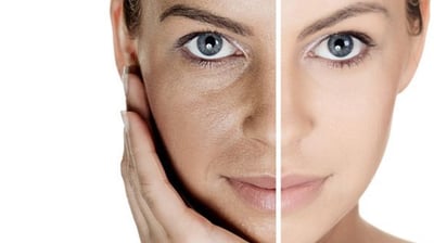 Acne treatments