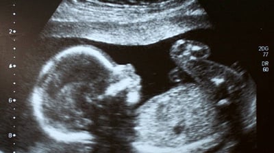 Imagem de ultrassonografia mostrando um bebê em detalhes