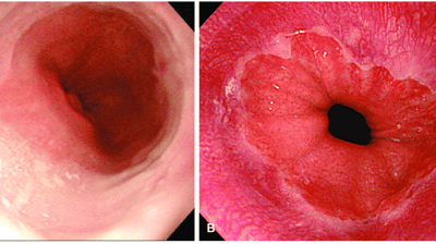 Imagem de uma Endoscopia mostrando o trato gastrointestinal