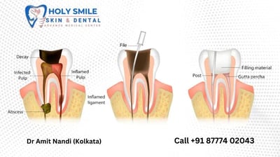 affordable root canal treatment in kolkata