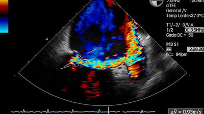 ecocardiograma doppler adulto morelia dicava