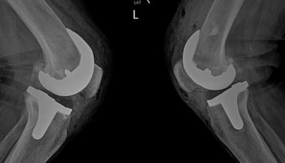 protesis de rodilla