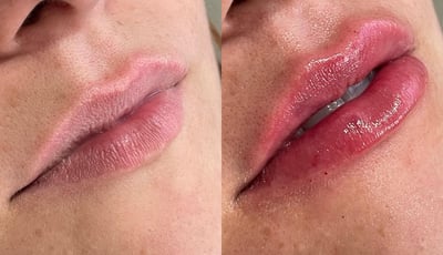Preenchimento labial natural, sem exageros. Tecnica lipkiss
