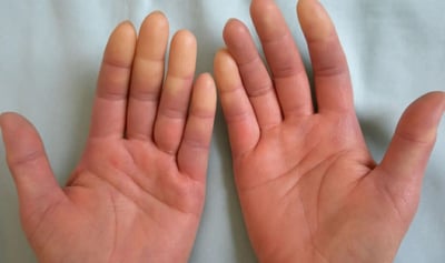 https://lasalute-clinic.ru/flebologiya/sindrom-rejno