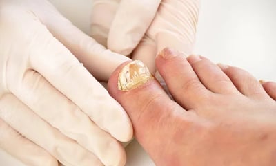 Micose de Unha ou Micose Plantar Podologia em Praia Grande