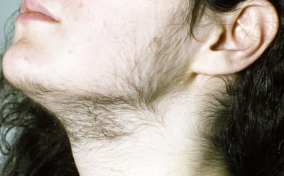 hirsutism condition