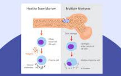 multip[e myeloma
