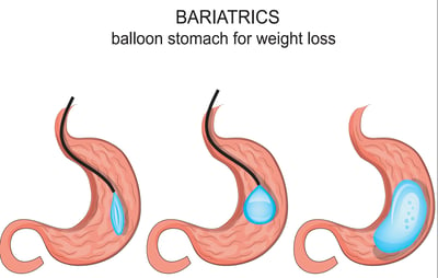 gastric ballon