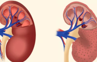Best Chronic Kidney Disease treatment in Madinaguda