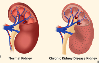 chronic kidney disease