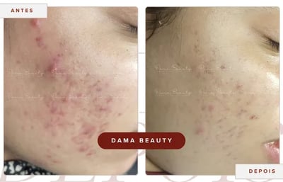 a woman with acneptictictictic and acneptictic treatment on