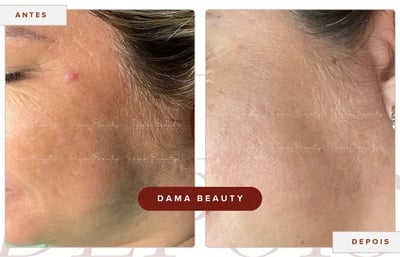 a woman with a large scarnap on her face and a before and after