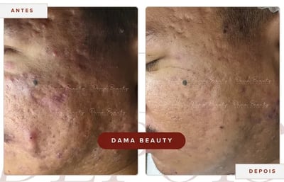 a woman with acnebrac deresing and acne