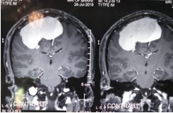 Giant meningioma in the midline