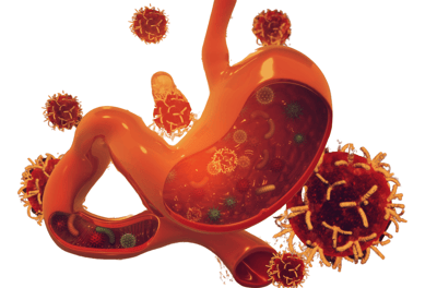 Stomach Cancer treatment in ahmedabad