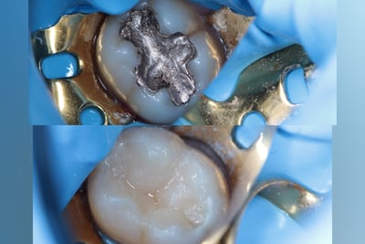 dentist in Athens, Composite resin, aesthetic dentistry, composite filling