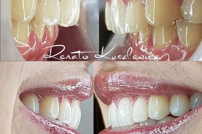 Antes e depois