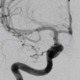 Angiografia digital após a cirurgia no cérebro e clipagem do aneurisma cerebral.