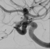 Angiografia digital após a cirurgia no cérebro e clipagem do aneurisma cerebral.