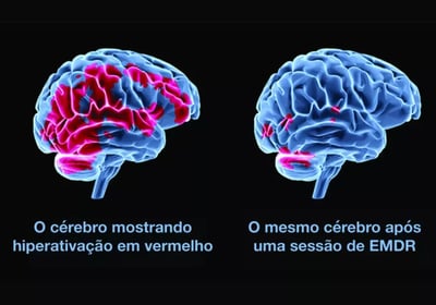 Comparação tridimensional do cérebro antes e depois de EMDR, mostrando redução de hiperatividade.