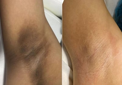Eliminación de manchas y reducción de vello en axilas mediante láser