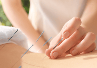 acupuntura. saúde natural. dry needling. medicina chinesa. terapias naturais. dor crônica