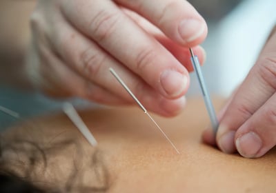 Wednesfield Acupuncture Clinic