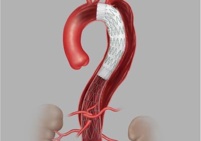 Endovascular Endoprótese