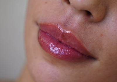 preenchimento labial