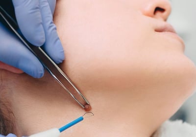 Eliminacion verrugas con tecnologia laser