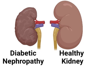 diabetic kidney disease