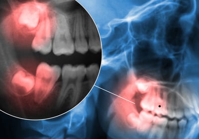 Dentist providing urgent treatment to a patient experiencing severe tooth pain in a dental clinic