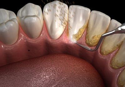 Dental professional performing a gum health evaluation as part of comprehensive periodontal services