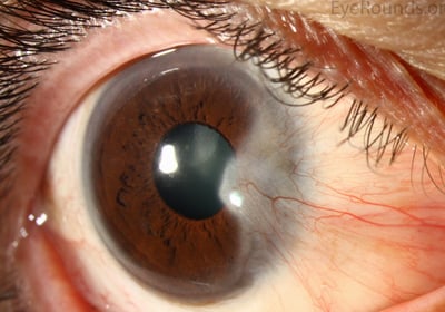 foto do pterígio, carne crescida nos olhos, olho seco, cirurgia de pterigio